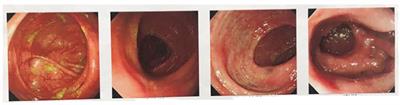 Intestinal Behcet’s syndrome with an unusual complication bladder-intestines fistula and urinary tract infections—A case report